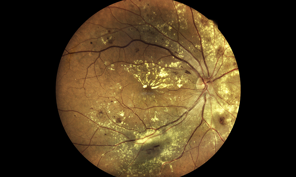 Age-related macular degeneration