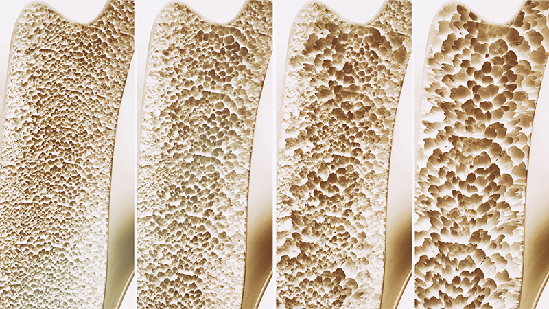 Gene Linked to Osteoporosis Risk in Postmenopausal Asian Women